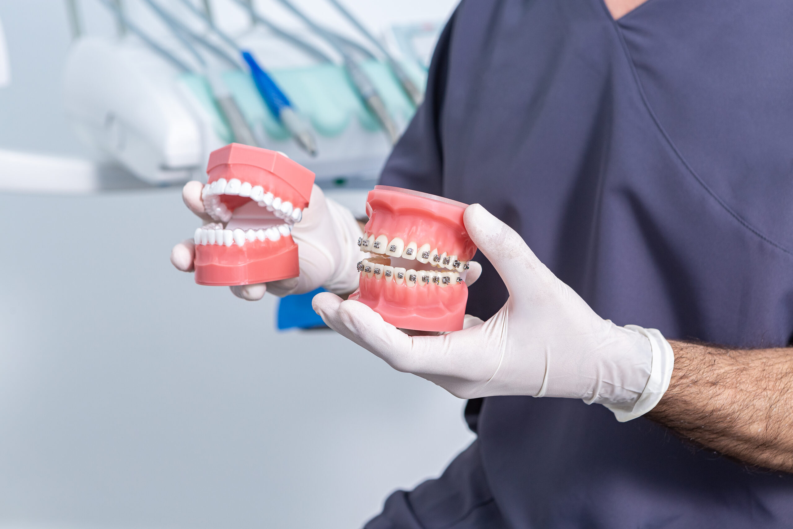 Traditional Braces Vs. Clear Braces